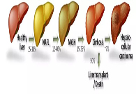 谈肝色变肝病NASH的索求之路