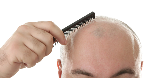 “世纪难题”脱发的医治迎来新曙光