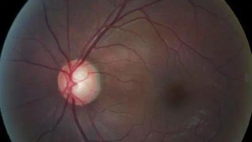 青光眼的克星来袭，助力患者远离视力的“窃贼”