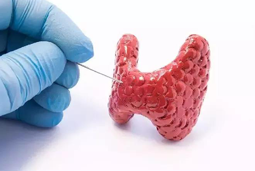 甲状腺疾病，蕴含甲状腺职能减退和甲状腺职能亢进，自古以来就是反复被医学钻研人员钻研的疾病
