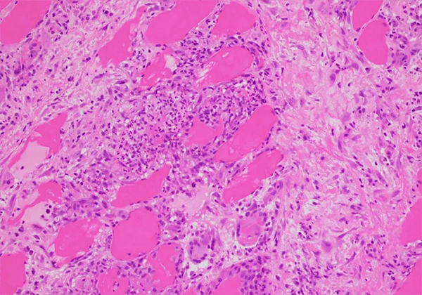 【PP电子游戏助力】医治结节病的KBMAB-16获FDA核准临床